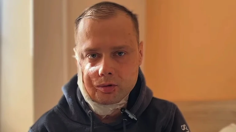 З дитинства не міг жувати: у Львові відновили обличчя Захиснику
