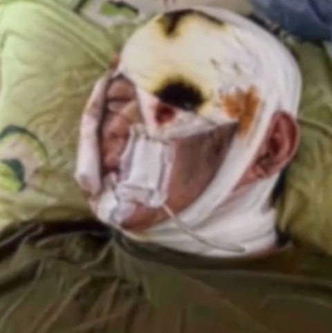 Мережею шириться відео нібито солдата КНДР, який вижив внаслідок удару ЗСУ